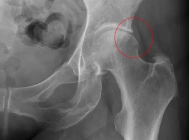 Kalca Agrisi Femoroasetabular Sikisma FAS FAI Nedir