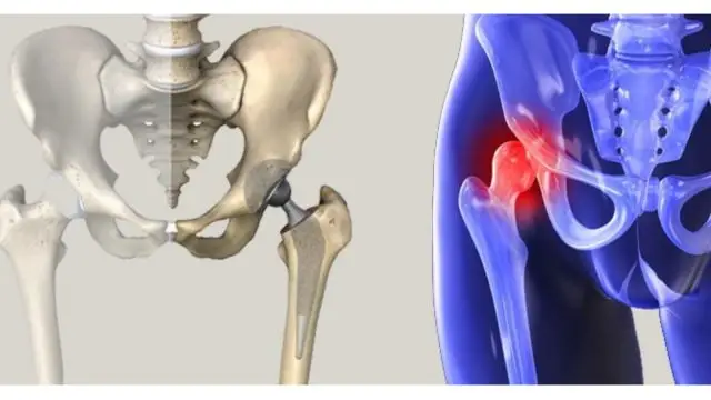 Kalca Anatomisi ve Minimal Invaziv Kalca Protezi