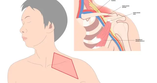 Pleksus Yaralanmalari Nedir