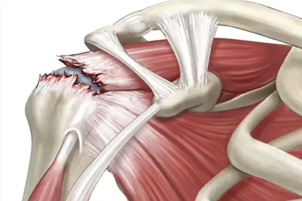Rotator Kuf Sendromu Nedir