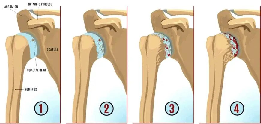 omuz kireclenmesi cesitleri