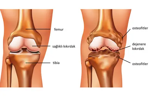 Diz Onu Agrisi Patellofemoral Sendrom Nedir