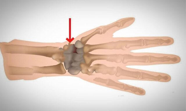 Blog 6 el bilegi kiriklari